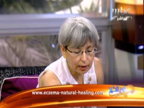 العلاج الطبيعي لمرض الاكزيما Natural healing for eczema