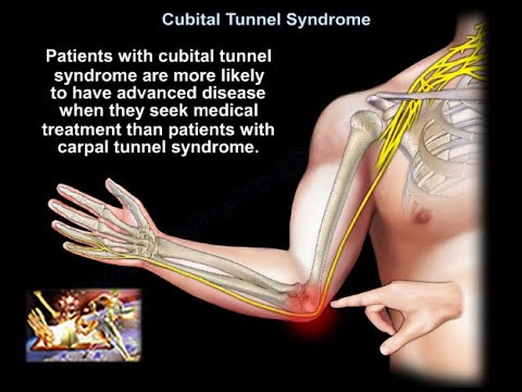 Síndrome del túnel cubital - Todo lo que se debe saber 