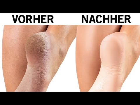 Ob man gribok vom Peroxid heilen kann Mikosan die Mittel von gribka der Nägel die Rezensionen der Preis