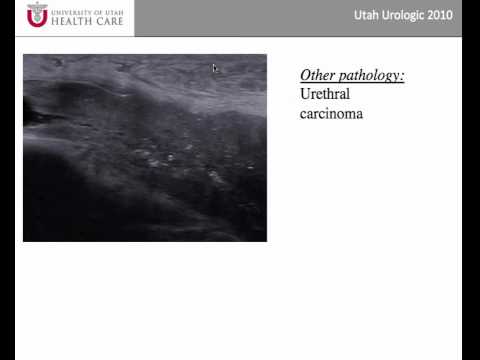 Anterior Urethral Strictures - Part 1