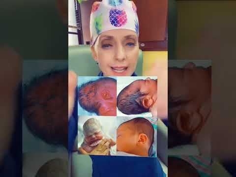 Newborn conehead or caput! #conehead #caput #birth #childbirth #laboranddelivery
