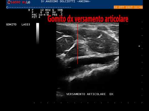 Mal di schiena e le mani nel trattamento dellanca Se è possibile fare esercizio di lombalgia acuta