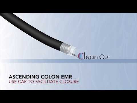 Colonoscopy: Ascending Colon Polyp EMR+APC+Clip - Audio