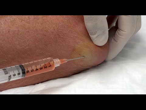 Schmerzen im linken Hüftgelenk beim Gehen Zervikale Osteochondrose ukrainische Resorts