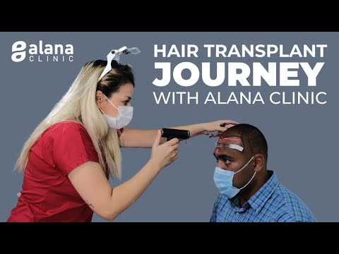 HAIR TRANSPLAT JOURNEY | ALANA CLINIC