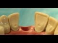 Maryland Bridge For Dental Students
