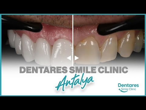 Dentares Smile Clinic Antalya, Turkey is the best choice to solve your dental problems.
