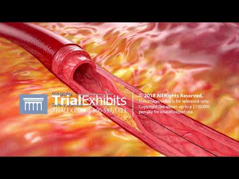 3D Medical Animation of Coronary Angioplasty with Stent Placement