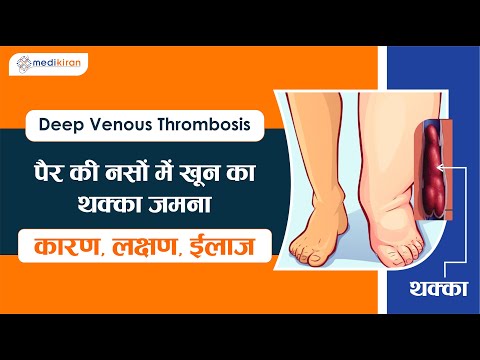 Leg swelling and Deep venous thrombosis (DVT) - Dr. Pushan Sharma