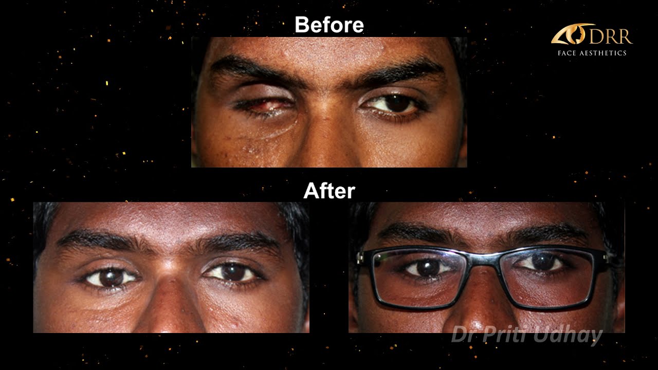 Artificial Eye Fitting, Prosthetic Eye Surgery