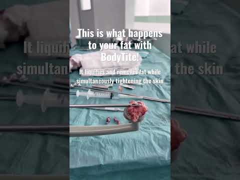 This is how Bodytite works 😎 #plasticsurgeon #bodycontouring #beauty #tightening #contouring