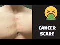 I Got Cancer Again - What This Means For My Career and Bodybuilding