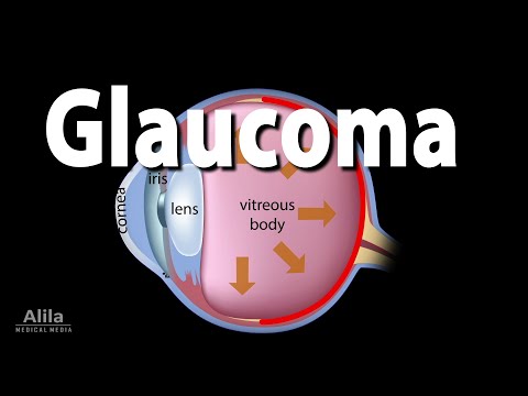 Development of Glaucoma Animation, Open Angle vs Angle Closure Glaucoma