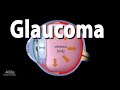 Development Of Glaucoma Animation Open Angle Vs Angle Closure Glaucoma