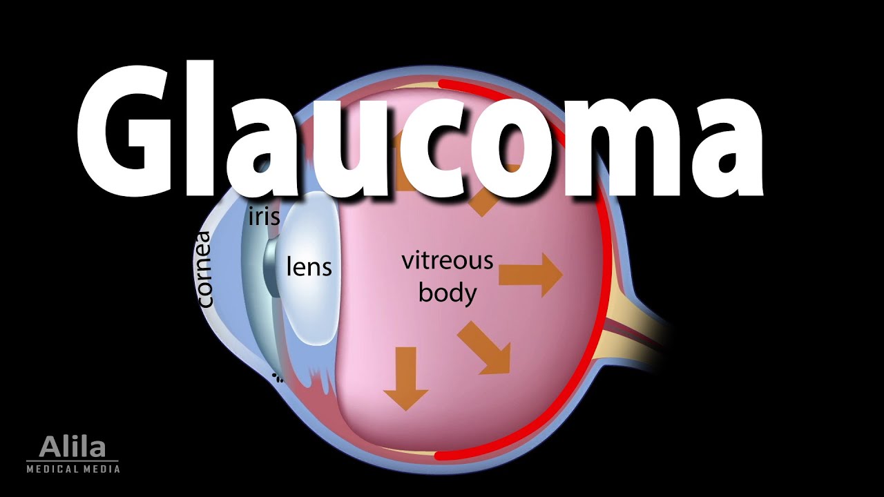 Development of Glaucoma Animation, Open Angle vs Angle Closure Glaucoma.