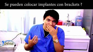Con Implantes Dentales Se Puede Poner Brackets Clinica Dental Velez CDMX- Doctor Erick Vélez
