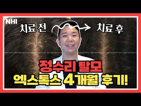 남자 정수리 탈모 엑스톡스 4개월 후기(+미녹시딜,아보다트)ㅣ뉴헤어
