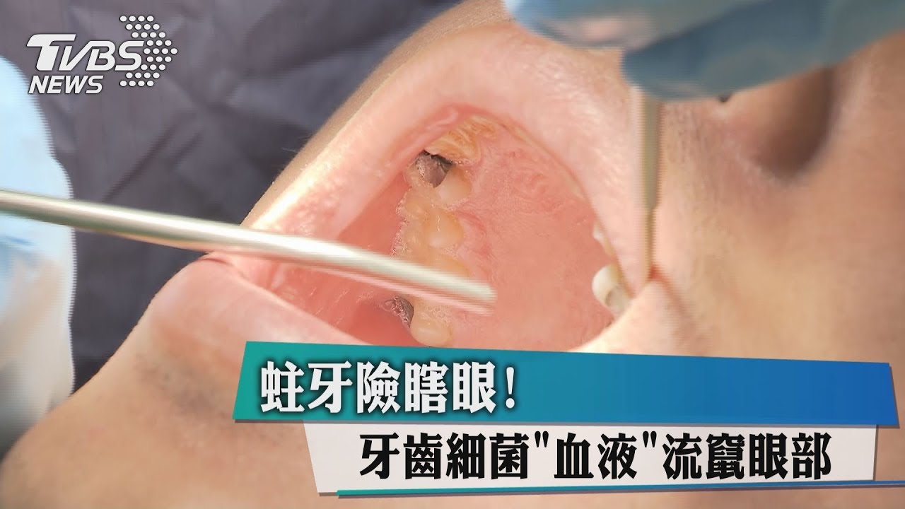 蛀牙險瞎眼! 牙齒細菌「血液」流竄眼部