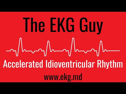 Accelerated Idioventricular Rhythm EKG l The EKG Guy - www.ekg.md