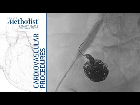 Coiling i stentgrafting tętniaka tętnicy biodrowej wewnętrznej