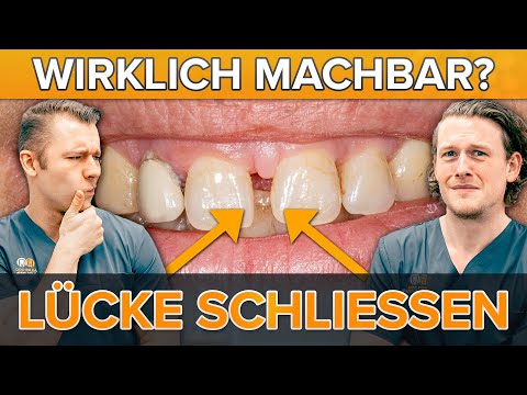 Frontzahnlücken schließen mit Komposit / Kunststoff - So klappt es! (inkl. Vorher Nachher)
