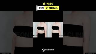 대용량 팔뚝 지방흡입 이래도 안해?