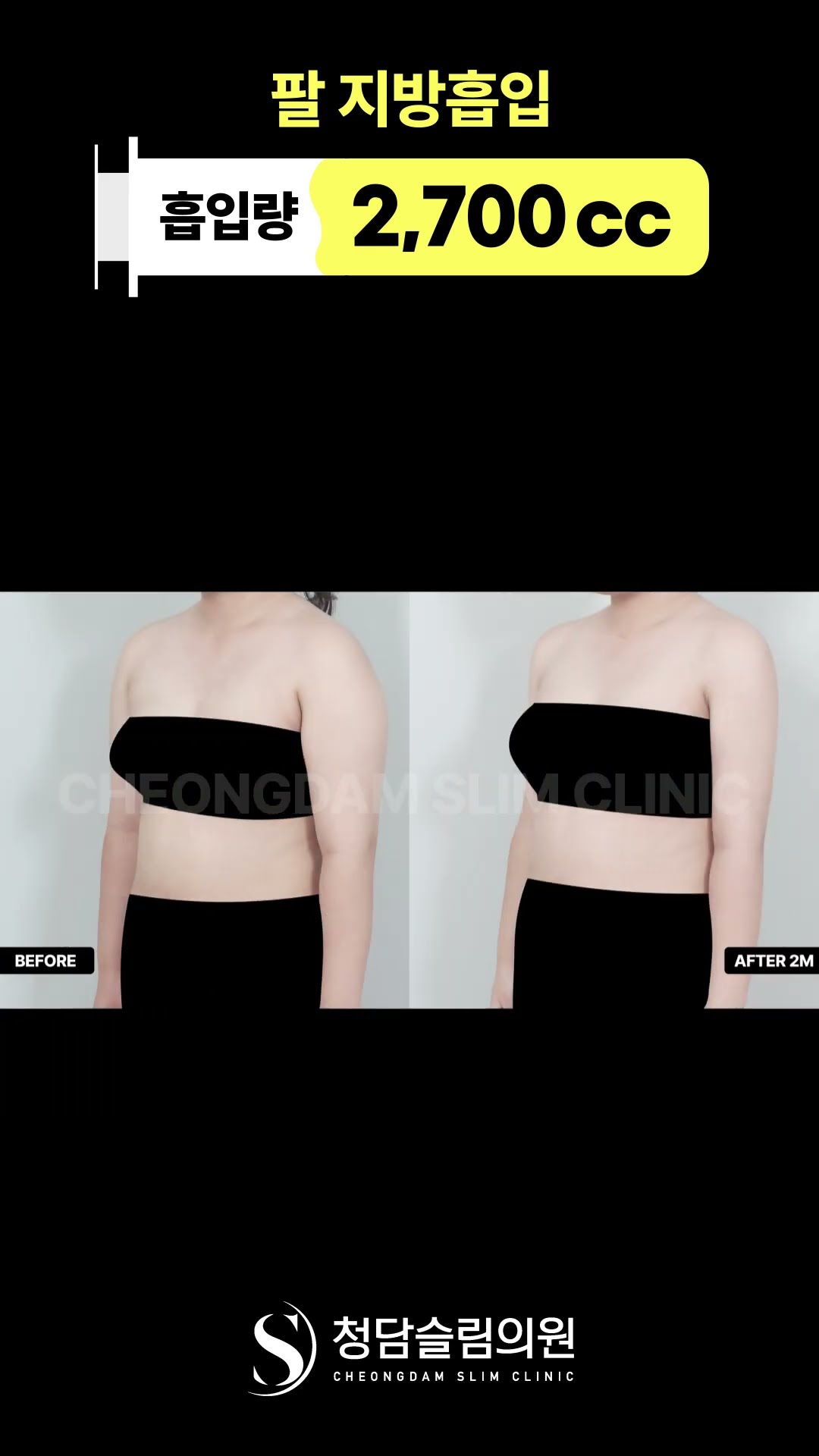 대용량 팔뚝 지방흡입 이래도 안해?