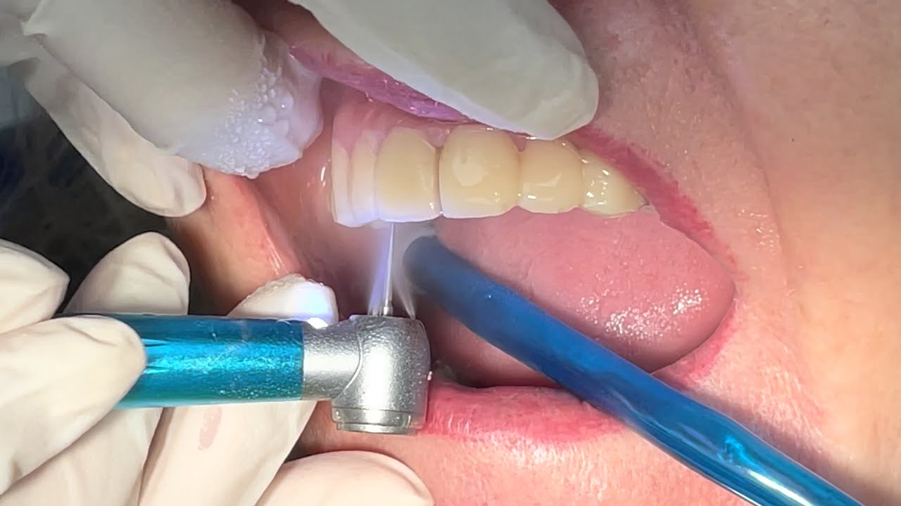 Watch Now RIMOZIONE PONTE & CORONA DENTALE PROVVISORIO RIMOZIONE PONTE & CORONA DENTALE PROVVISORIO