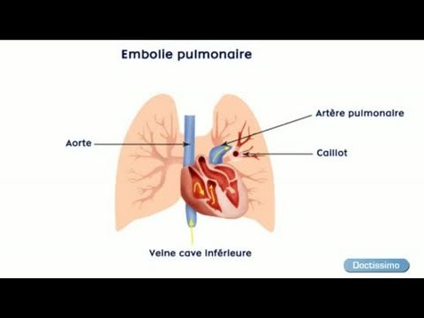 comment soigner thrombose veineuse