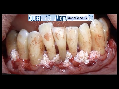 Periodontologia chirurgiczna - zęby dolne