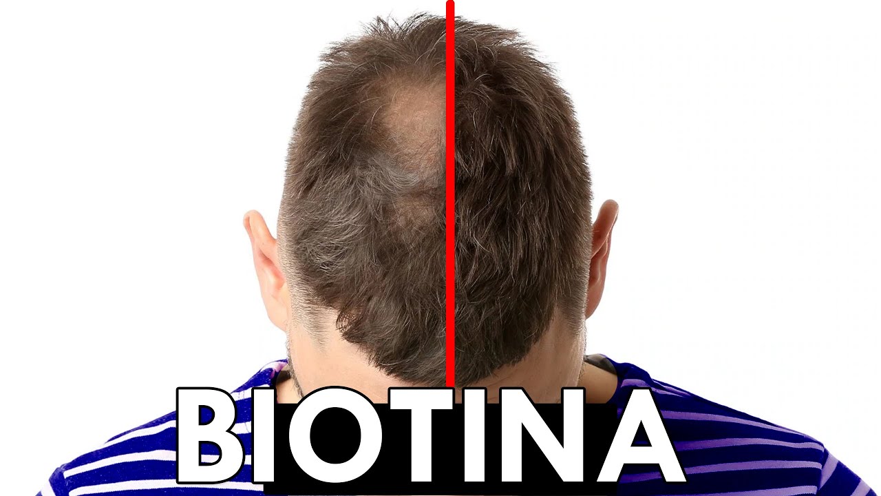 Watch BIOTINA para el PELO explicado por MÉDICO: ¿FUNCIONA Now BIOTINA para el PELO explicado por MÉDICO: ¿FUNCIONA