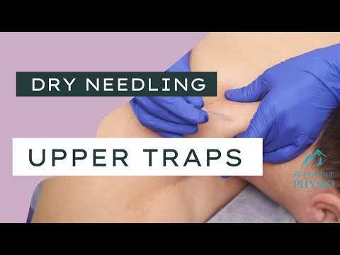 Intramuscular Stimulation for Shoulders and Neck Tension; Headaches (North Van Physio)