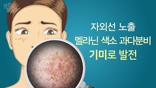 가을 햇빛도 흔적을 남긴다! 기미에 관한 모든 것 [건강플러스] 미리보기