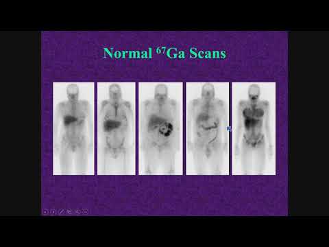 Infection and Inflammation Scintigraphy by Christopher J. Palestro, M.D., FSNMMI