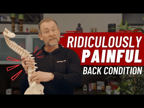 Lumbar Radiculopathy = Ridiculously Painful! | Health Matters