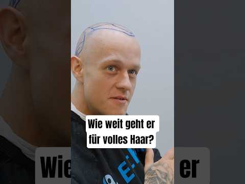 Haartransplantation: Volles Haar um jeden Preis? 💇‍♂️⚠️