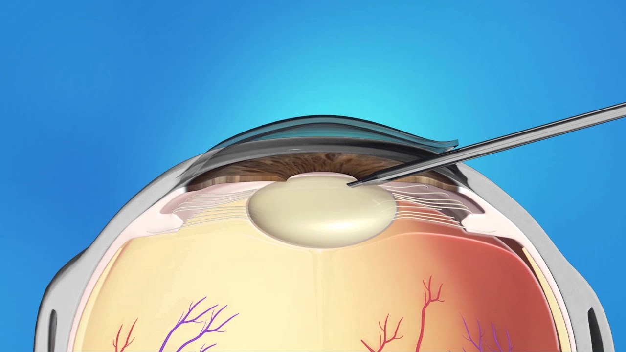 Cataract Surgery for Children