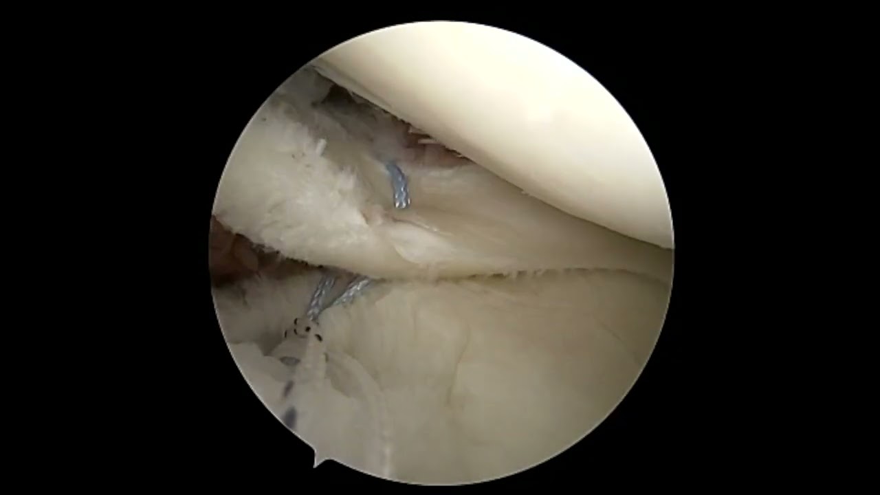 ACL with lateral meniscal radial repair with the new Sutureloc