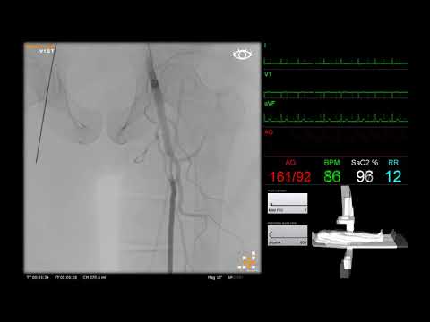 Peripheral Angiography