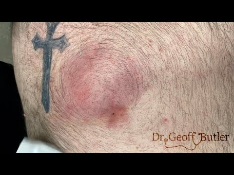 Drainage of a deep abscess on the back
