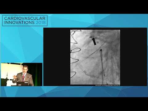 CVI2018 Session: "Between Scylla and Charybdis": The case of the Rotablator - K. Dean Boudoulas, MD
