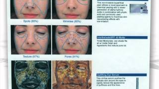 preview picture of video 'VISIA Complexion Analysis at Sedona Skin Spa Edina and Mendota Heights MN 952-929-4404'