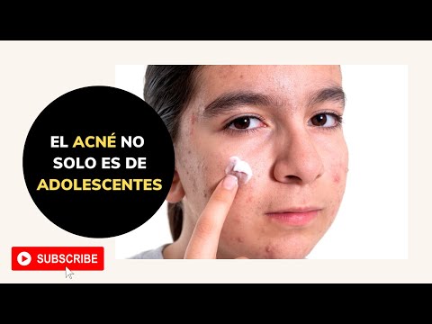 El acné NO solo es de ADOLESCENTES