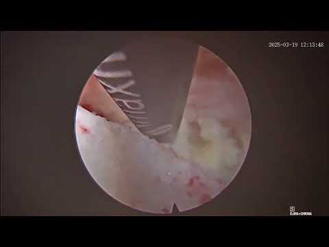 Surgical Video