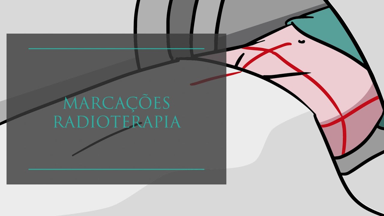 Marcações da Radioterapia