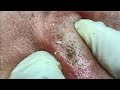 Acne treatment in Ha Quyen Spa on 30/06/2019 part 3 - Điều trị mụn tại Hà Quyên Spa Acne treatment in Ha Quyen Spa on 30/06/2019 part 3 - Điều trị mụn tại Hà Quyên Spa
