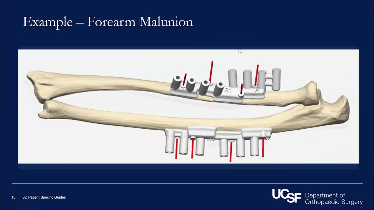 26: 3D Revolution: Patient Specific Guides for Upper Extremity Deformity Correction | Igor Immerman, MD