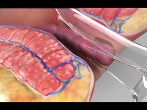 Lazer Hemoroid Ameliyati