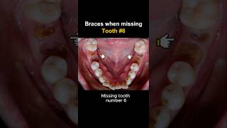 Download lagu Braces for missing tooth 6 #braces #orthodontist #brackets #dentist mp3