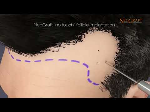 Florida NeoGraft Hair Transplant Animation at Ennis Plastic Surgery